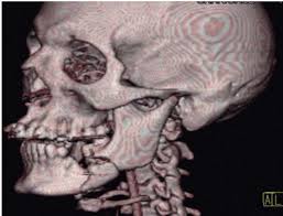 image of a bullet lodged in a jaw